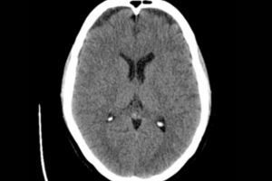 Ct Scan Brain