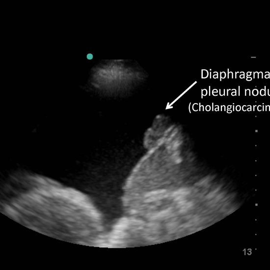 Ultrasound Scan For Guided Pleural Aspiration