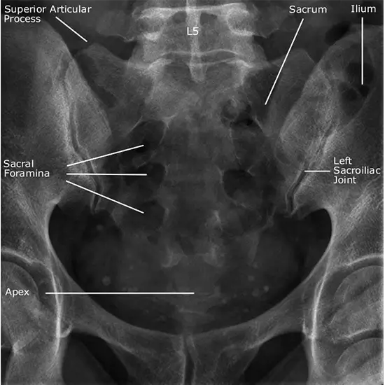 X-Ray Sacral AP/Lateral