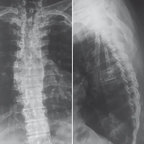 X-Ray of the Thoracic Spine (AP/Lateral View)