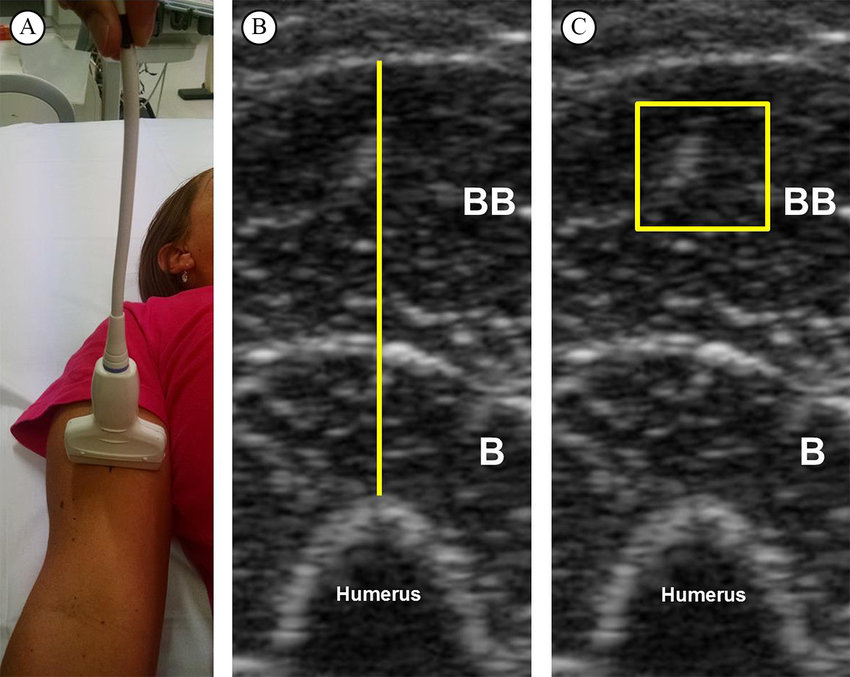 Ultrasound Scan For Forearm
