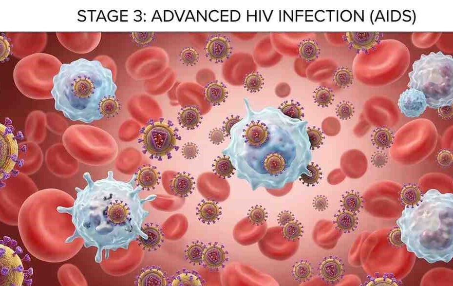 Advanced HIV Infection