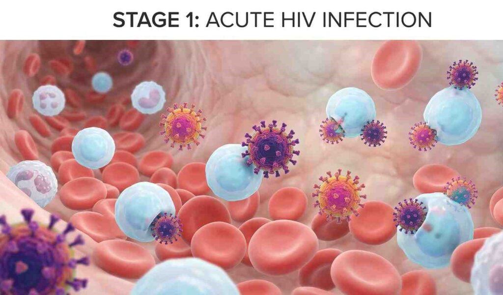 ACTUE HIV INFECTION