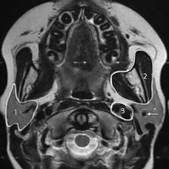 MRI Scan for Parotid