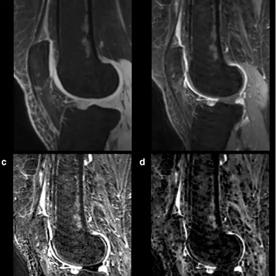 MRI Scan for Knee Joint One Side