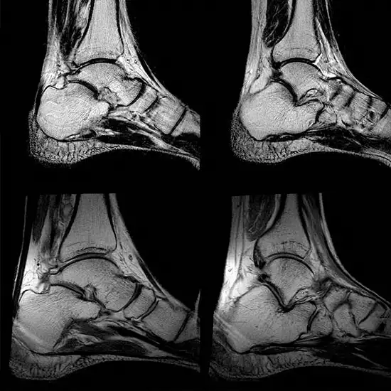 MRI Scan for Foot Left