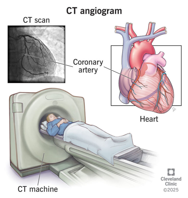 CT Angiography