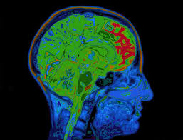 MRI Brain Scan