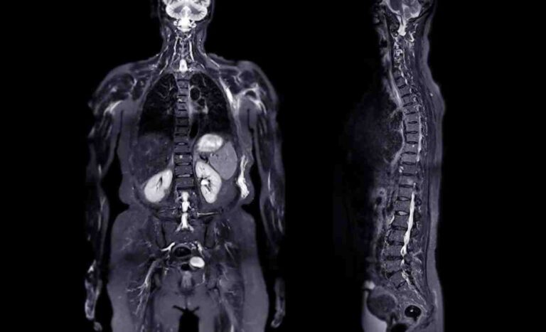 Spine MRI Scan