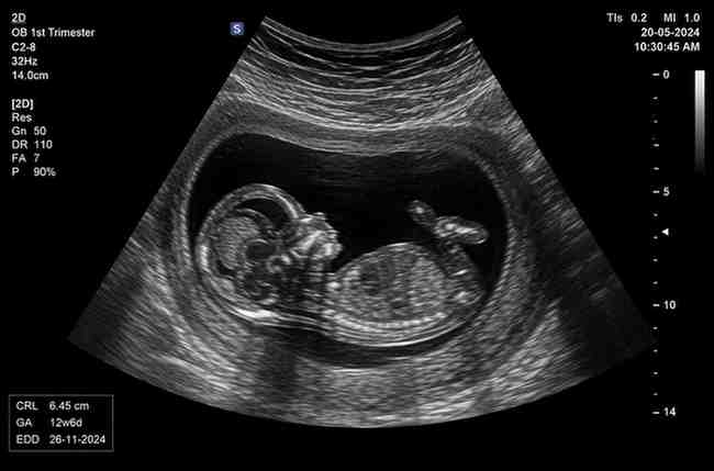 2D-Ultrasound-Scan