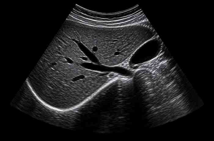 Abdominal-Ultrasound-Scan
