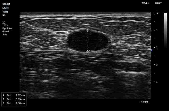 Breast Ultrasound Scan