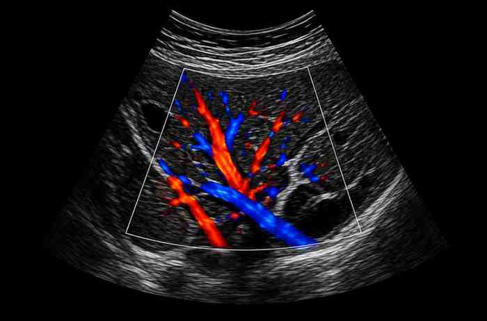 Doppler-Ultrasound-Scan