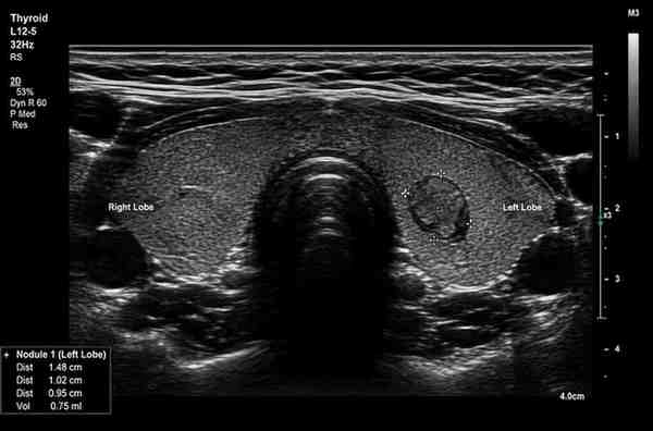 Thyroid Ultrasound Scan