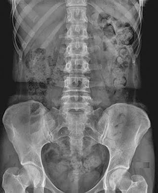 Abdomen X-Ray