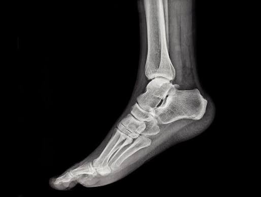 Ankle X-Ray