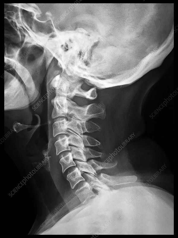 Cervical Spine X-Ray