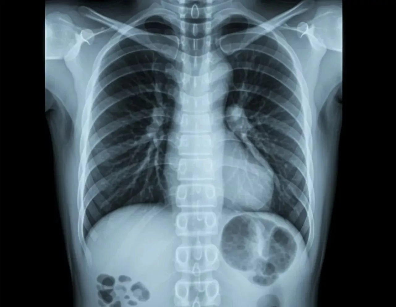 Chest X-Ray