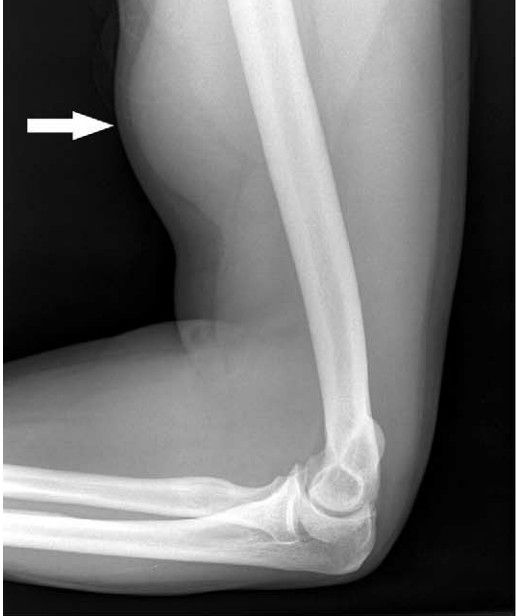 Elbow X-Ray