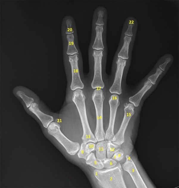 Hand X-Ray