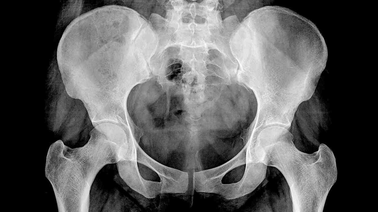 Hip X-Ray
