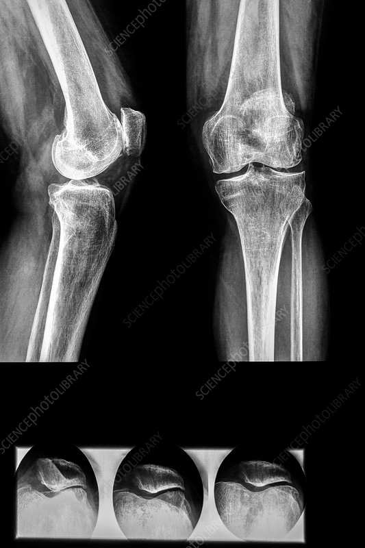 Knee X-Ray