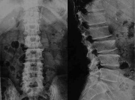 Lumbar Spine X-Ray