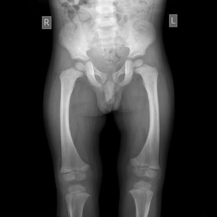 Pelvis X-Ray