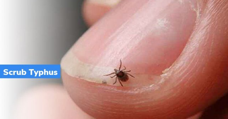 Scrub Typhus