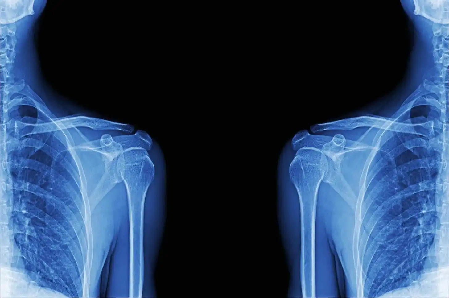 Shoulder X-Ray