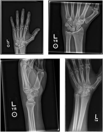 Wrist X-Ray