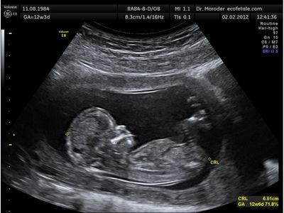 Ultrasound Scan Test for Pregnancy